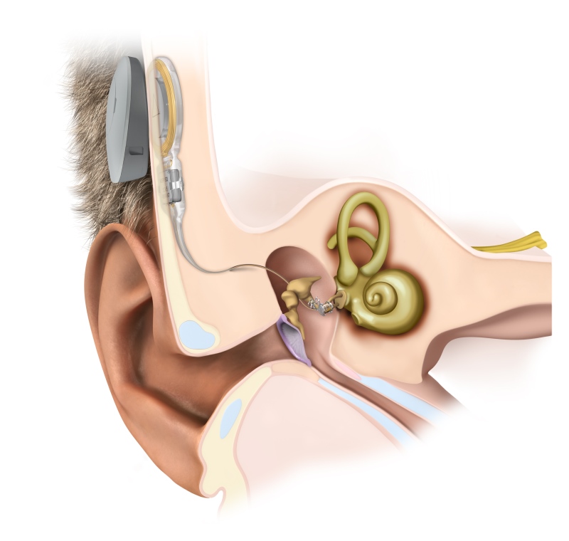 Vibroplasty Treatment for hearing loss | MED-EL VIBRANT ... cochlea diagram inner ear 